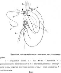 Способ ушивания раны почки при лапароскопическом органосохраняющем лечении рака почки в условиях тепловой ишемии (патент 2532897)