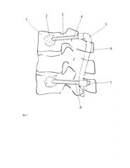 Устройство для перкутанной транспедикулярной стабилизации позвоночника (патент 2583245)