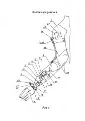 Протез предплечья (патент 2615278)