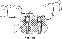 Способ обеспечения индивидуальной для пациента конструкции, сопрягающейся с зубным фиксатором (патент 2575144)