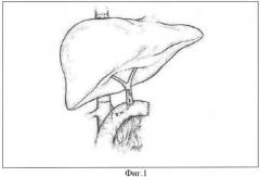Способ восстановления оттока желчи при ортотопической трансплантации печени (патент 2347536)