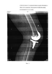 Способ восстановления надколенника при тотальном эндопротезировании коленного сустава (патент 2592025)
