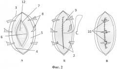 Способ аллопластики при послеоперационных вентральных грыжах (патент 2570760)