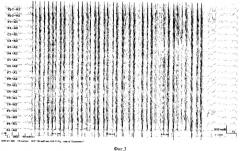 Способ диагностики фотосенситивной эпилепсии (патент 2336812)
