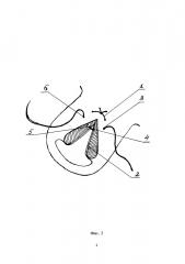 Способ проведения пластической операции на шейке матки при ее рубцовой деформации (патент 2663635)