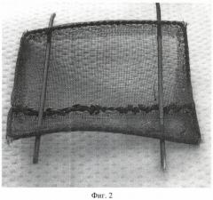 Способ хирургического лечения рака гортани (патент 2487681)