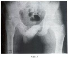 Способ этапного хирургического лечения прогрессирующего туберкулеза тазобедренного сустава (патент 2463979)