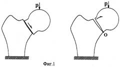 Способ компрессионного остеосинтеза переломов шейки бедра (патент 2254085)