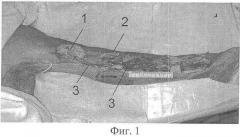 Способ одномоментной несвободной костной аутопластики при дефектах и ложных суставах обеих костей предплечья (патент 2360632)