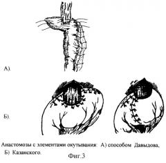 Новый способ формирования эзофагогастроанастомоза в условиях недостатка пластического материала путем модификации задней губы (патент 2248185)