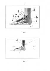 Способ лечения продольного плоскостопия (патент 2624371)