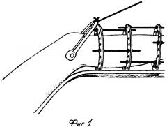 Устройство для оптимизации лечения односторонних переломов длинных костей нижних конечностей (патент 2275879)