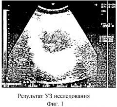 Способ предоперационной подготовки больного с острой постнекротической кистой поджелудочной железы к наложению панкреатоцистодигестивного анастомоза (патент 2294701)