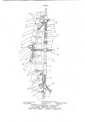 Устройство для коррекции позвоночника (патент 888968)