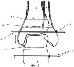 Способ восстановления поврежденных связок голеностопного сустава (патент 2445015)