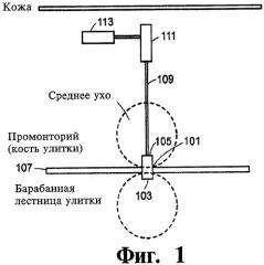 Имплантируемое устройство и способ доставки текучего лекарственного препарата в ткань (патент 2423154)