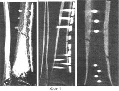 Способ лечения замедленной консолидации, несрастающихся переломов трубчатых костей (патент 2572004)