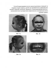Способ моделирования костно-реконструктивных операций на лицевом отделе черепа у детей при приобретенных деформациях нижней и верхней челюстей, связанных с анкилозированием височно-нижнечелюстного сустава после гематогенного остеомиелита и/или родовой травмы (патент 2604774)