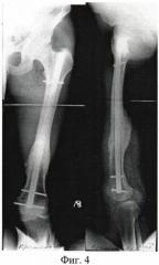 Способ лечения больных с застарелыми, неправильно сросшимися переломами бедренной кости (патент 2445032)