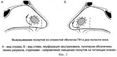 Способ пластического закрытия субтотальных перфораций перегородки носа у детей (патент 2246910)