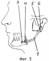 Способ костной пластики нижней челюсти (патент 2281704)