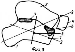 Способ лечения плоско-вальгусной деформации стопы у детей (патент 2311145)