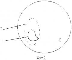 Способ уретероцистонеоанастомоза при раке мочевого пузыря (патент 2271159)