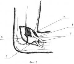 Способ хирургического лечения подкожного разрыва дистального сухожилия двуглавой мышцы плеча (патент 2477093)