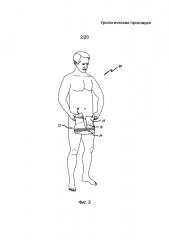 Урологическая прокладка (патент 2660041)