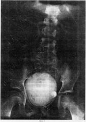 Способ рентгенодиагностики степени пузырно-мочеточникового рефлюкса у детей (патент 2283621)