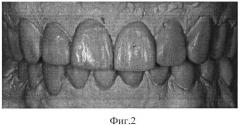 Способ эстетической реставрации зубов (патент 2529398)