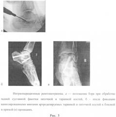 Малоинвазивный артродез подтаранного сустава (патент 2549297)