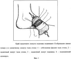 Способ формирования культи стопы (патент 2308244)