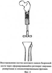 Способ хирургической коррекции дефектов дистальных отделов бедренной кости (патент 2356505)