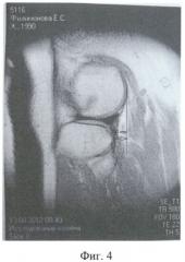 Способ магнитно-резонансной томографии для определения передней нестабильности коленного сустава (патент 2511400)
