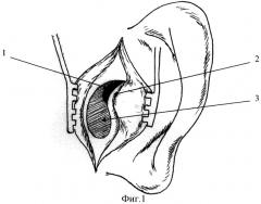 Способ хирургического лечения хронических гнойных средних отитов (патент 2316269)