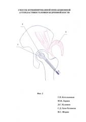 Способ комбинированной импакционной аутопластики головки бедренной кости (патент 2583577)