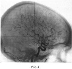 Способ лечения артериовенозных мальформаций головного мозга (патент 2534522)