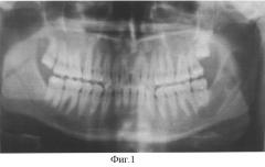 Способ восстановления костной ткани челюстей после операции цистэктомии (патент 2311181)