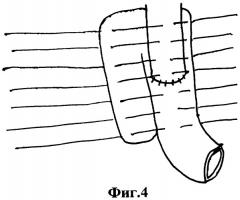 Способ формирования межкишечного анастомоза (патент 2272586)