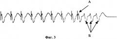 Способ прогнозирования желудочковых аритмий у кардиохирургических больных (патент 2246895)