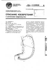 Способ резекции желудка (патент 1124936)