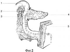 Способ завершения панкреатодуоденальной резекции при неизмененной ткани поджелудочной железы (патент 2272576)