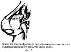 Способ органосохраняющего оперативного лечения больных с опухолевой патологией паренхимы почки (патент 2290095)