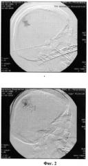 Способ хирургического лечения артериовенозной мальформации головного мозга (патент 2455949)