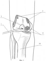 Способ аутопластики суставных поверхностей при деструктивно-дистрофических заболеваниях коленного сустава (патент 2484784)