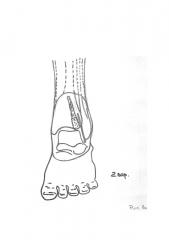 Способ лечения и профилактики деформирующего остеоартроза голеностопного сустава (патент 2611913)