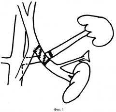 Способ односторонней портализации надпочечниковой и почечной крови (патент 2422101)