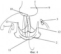 Способ хирургического лечения аневризм корня аорты с сохранением собственного клапана (патент 2294703)