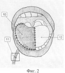 Способ реконструкции языка при обширных дефектах полости рта (патент 2391925)